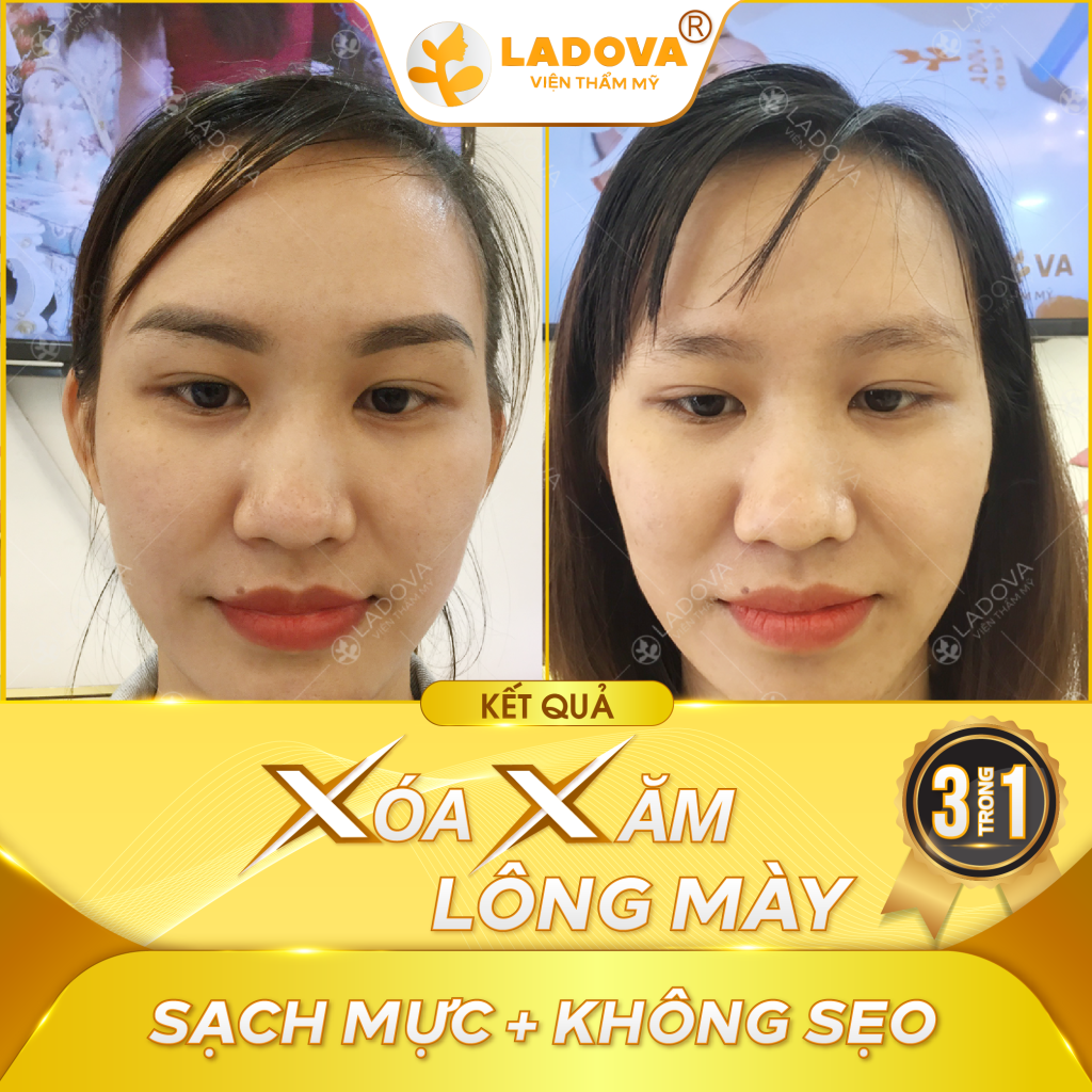 xoa-xam-long-may-01