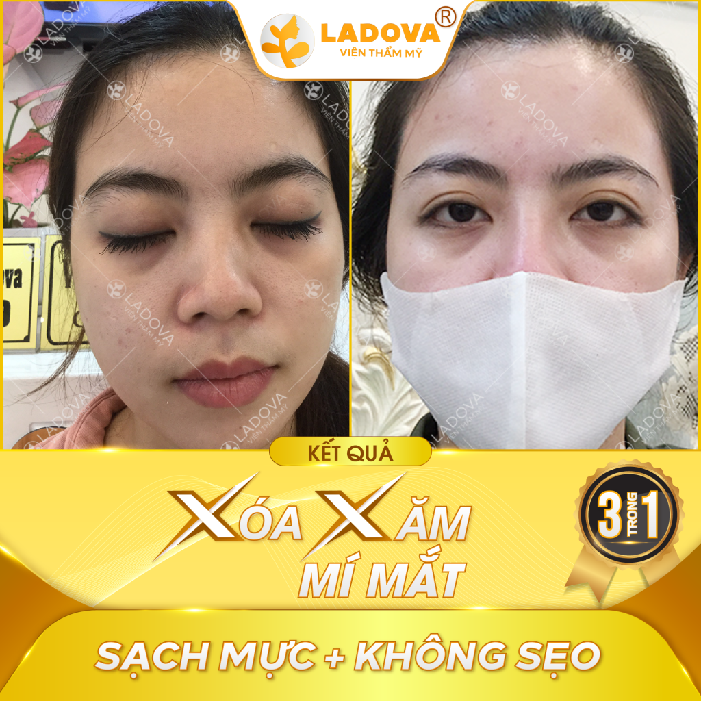 xoa-xam-mi-mat-o-dau-01