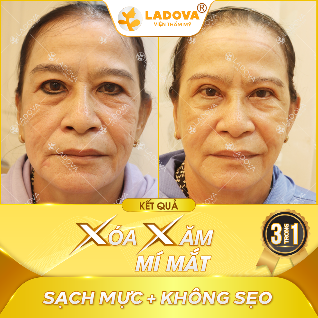 xoa-xam-mi-mat-tan-goc-01