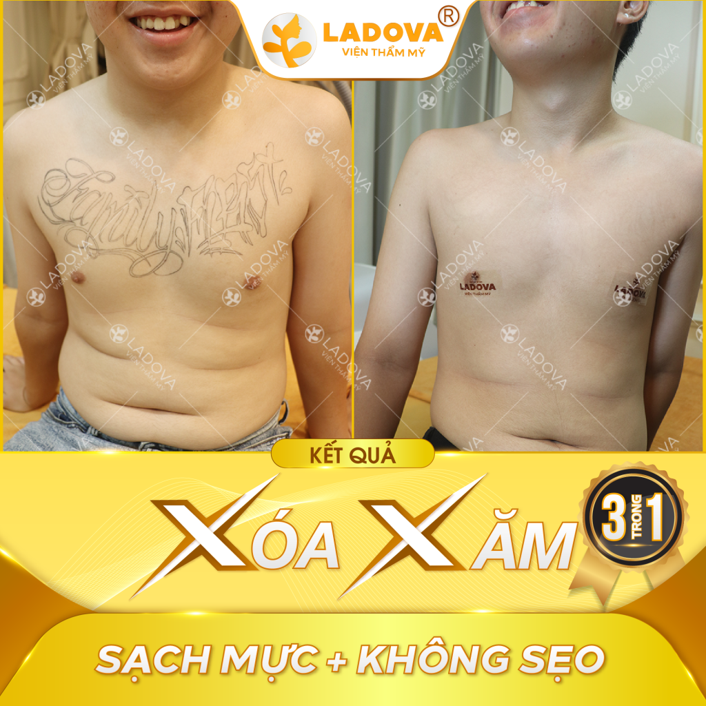 xoa-xam-tren-nguc-01